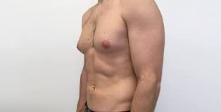 gynecomastia surgery in Lahore