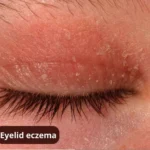 eczema on eyes