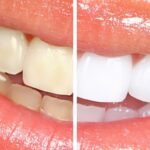 Rinse with Salt Water for Natural Gum Care