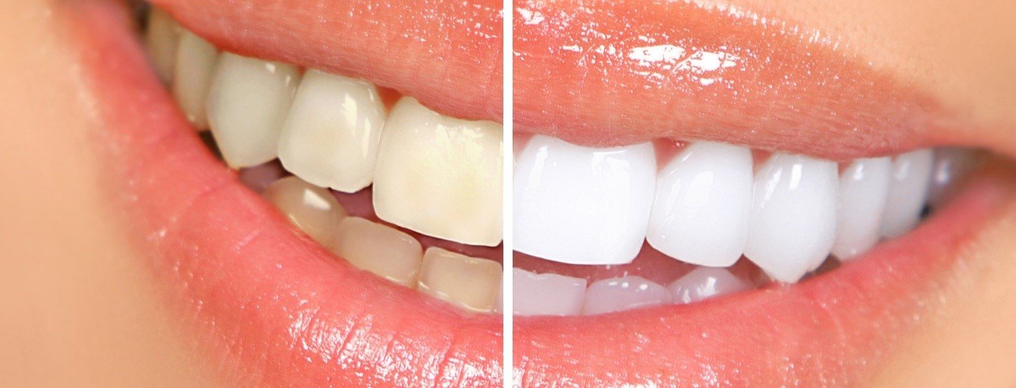 Rinse with Salt Water for Natural Gum Care